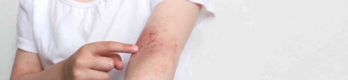 Atopik Dermatit Nedir? Belirtileri, Nedenleri ve Tedavisi