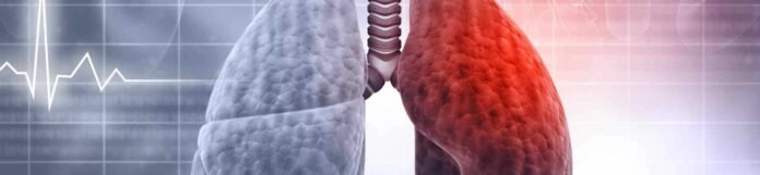 Bronşektazi Nedir? Bronşektazi Belirtileri Nelerdir?
