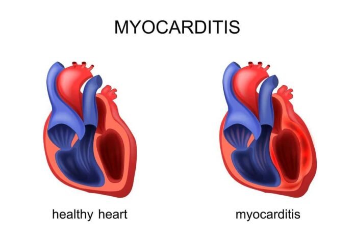 Kalp Kası İltihabı (Miyokardit) Nedir? Miyokardit Belirtileri ve Tedavisi