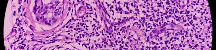 Liken Planus Nedir? Belirtileri ve Tedavisi
