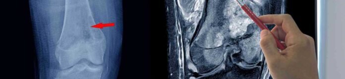 Osteosarkom Nedir? Belirtileri ve Tedavisi