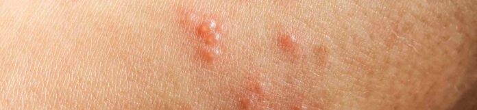 Pemfigus Nedir? Pemfigus Hastalığı Belirtileri Nelerdir?