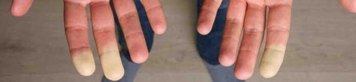 Raynaud sendromu nedir?
