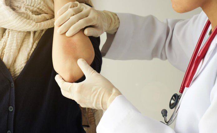 Sedef Hastalığı (Psoriasis) Nedir? Belirtileri ve Tedavisi