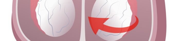 Testis Torsiyonu Nedir? Belirtileri, Nedenleri ve Tedavisi